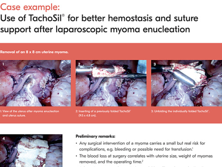 Use of TachoSil® for Better Haemostasis and Suture Support After Laparoscopic Myoma Enucleation