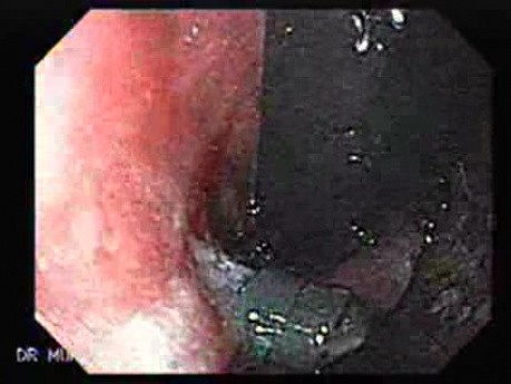 Hyperplastic Polyps - Endoscopy (14 of 14)