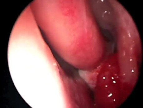 Removal of Sinus Granulation