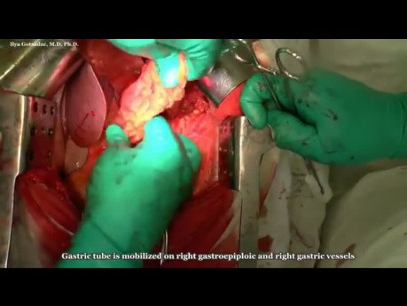 Transthoracic 2F Esophagectomy (Lewis Procedure)