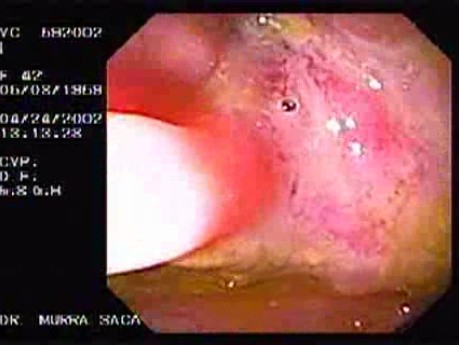 Crohn´s Disease (4 of 28)