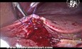 Control of the Bleeding Gallbladder Bed Sinusoids
