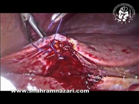 Control of the Bleeding Gallbladder Bed Sinusoids