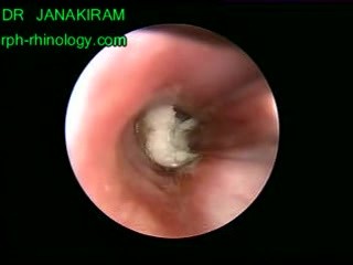 Bronchoscopy In A 15 Months Old Child