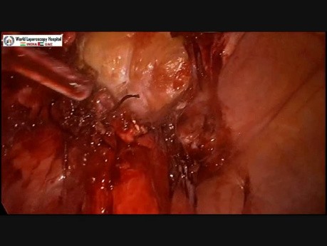 Recurrent Incisional Hernia with Severe Small Bowel Adhesion with Subacute Obstruction