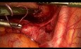 Laparoscopic Removal Of Pedunculated Myoma