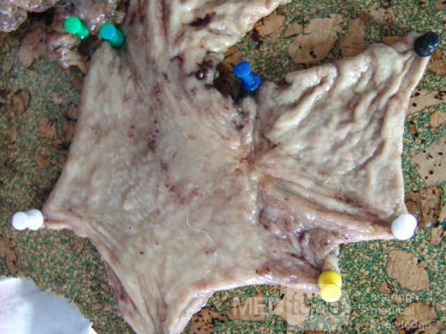 Small Gastric Adenocarcinoma of the Diffuse Ring Cell (16 of 19)