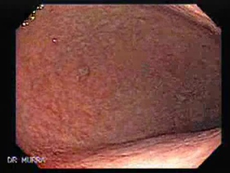 Adenocarcinoma of the Corpus and Fundus (4 of 4)