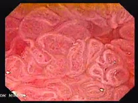 Rectal Adenocarcinoma (8 of 12)