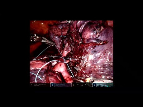 Robotic Upper Bi-Lobectomy