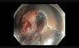 Colonoscopy - Rectum - Laterally Spreading Granular Tumor - EMR Part III
