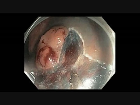 Colonoscopy - Rectum - Laterally Spreading Granular Tumor - EMR Part III
