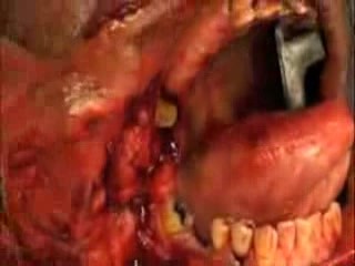 Carotid  Artery  Glomus  Chemodactoma  tumor  Surgery  Head  Neck  