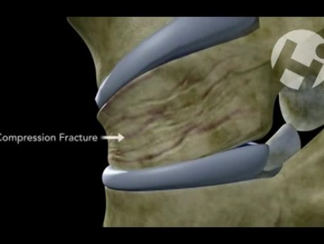 Compression Fracture vs. Displaced Shear Fracture