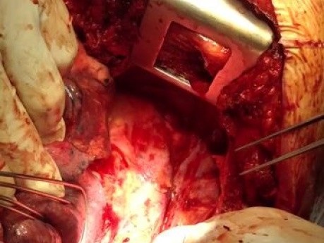 Traumatic Aortic Transection