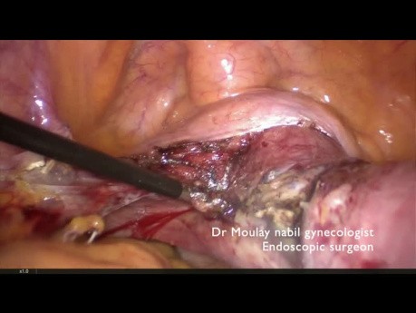 Total Hysterectomy and Appendicectomy