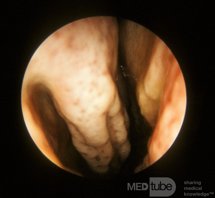 Post-Laryngectomy Atrophy of the Inferior Turbinate
