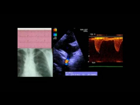 A Case of Coarctation of the Aorta: Discussion of the ECG, Echocardiogram and Treatment