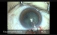 One Port Phacotrabeculectomy in Radial Keratotomy Patient with Glaucoma