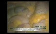 Laparoscopic Right Hemi-Coletomy