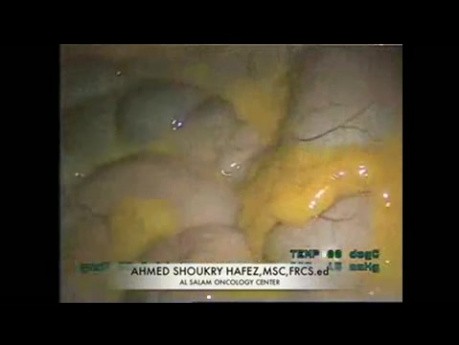 Laparoscopic Right Hemi-Coletomy