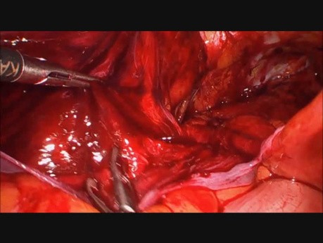 Bilateral Direct Hernia - TAPP with 3DMax Mesh XL