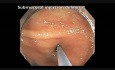 Colonoscopy Channel - Subtle Flat Lesion Revealed As Serrated Polyp