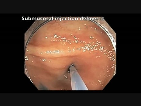 Colonoscopy Channel - Subtle Flat Lesion Revealed As Serrated Polyp
