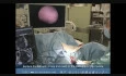 Hysteroscopic Resection of Cervical Myoma  