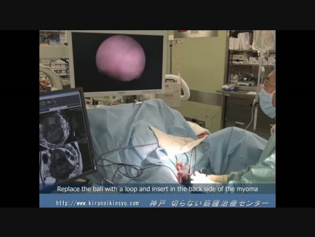 Hysteroscopic Resection of Cervical Myoma  