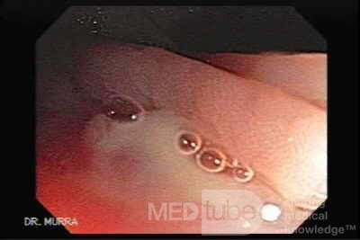 Diverticulum - Purulent Discharge