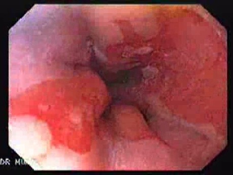 Barrett Esophagus (2 of 6)