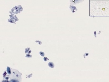 Atrophy - Histopathology - Cervix