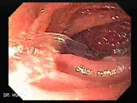 Esophageal Stricture After Total Gastrectomy And Chemoradiation - Baloon Dilation - 5/6