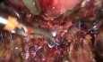 Recto-vaginal Nodule