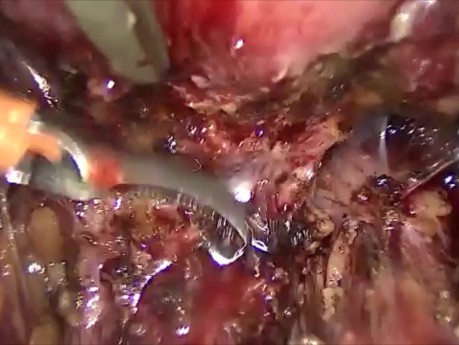 Recto-vaginal Nodule