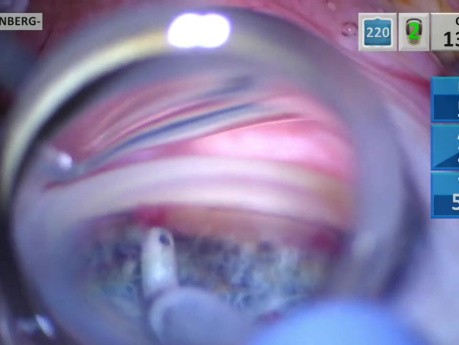Glaucoma Microstent Inject Technique Improvement 