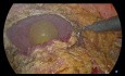 Laparoscopic Anterior Resection with un Block Partial Resection of the Urinary Bladder