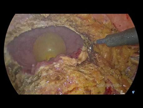 Laparoscopic Anterior Resection with un Block Partial Resection of the Urinary Bladder