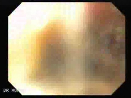 Synchronous Cancer (Gastric and Esophageal) -the Case of 60 Years-Old Man