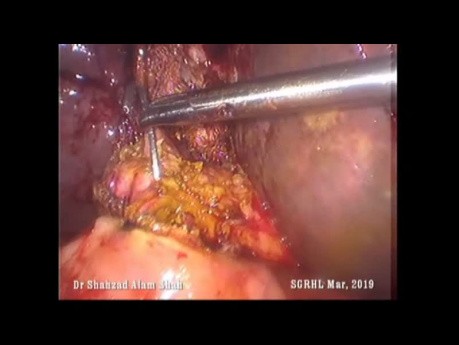 Laparoscopic Choledochoduodenostomy