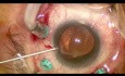Single Piece IOL Subluxation - Anterior Capsular Rhexis Optic Capture