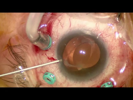 Single Piece IOL Subluxation - Anterior Capsular Rhexis Optic Capture