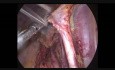 Pelvic Lymphadenectomy in Laparoscopy Werthems Hysterectomy