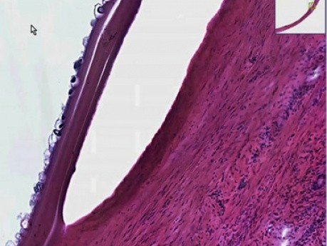 Echinococcus cyst