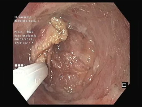 Flat Gastric Adenoma - Resection
