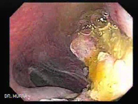 Colonoscopic Polypectomy (14 of 29)
