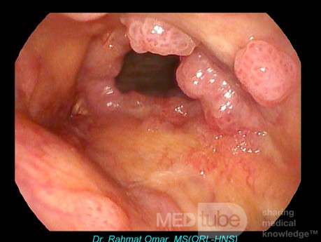 Recurrent Laryngeal Papillomatosis