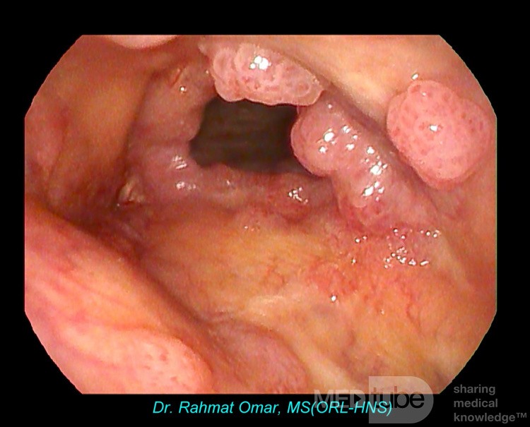 Recurrent Laryngeal Papillomatosis