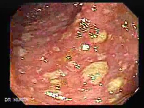 Rectum (4 of 30)